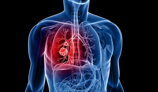 Iranian Scientists Produce Magnetic Nano-Fibers to Transfer Drugs to Lung Tumors