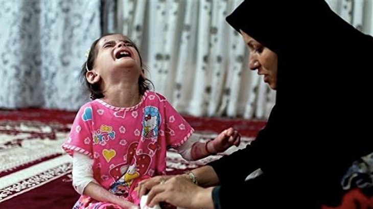 US sanctions on Iran killing children with EB: NGO