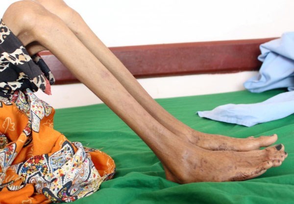 Starving Girl Shows Impact of Yemen War, Economic Collapse