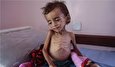 Syria and Yemen Need Aid Amid COVID-19 Pandemic