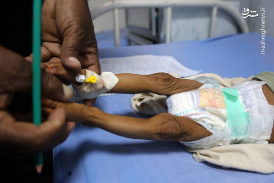  بحران سوءتغذیه کودکان در یمن

