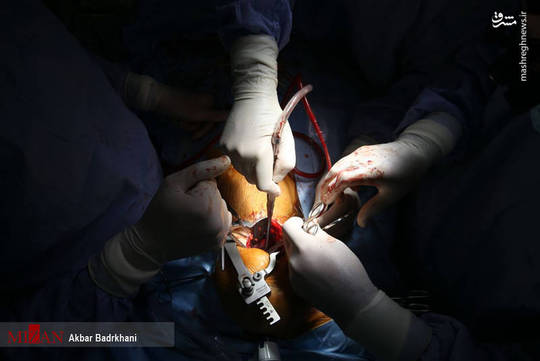 نخستین عمل جراحی قلب به روش کم تهاجمی در مرکز پزشکی شهیدمدرس دانشگاه علوم پزشکی شهیدبهشتی انجام شد.


