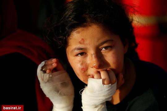دختر لیبیایی که در آتش سوزی در یک قایق مهاجران دچار سوختگی شده است